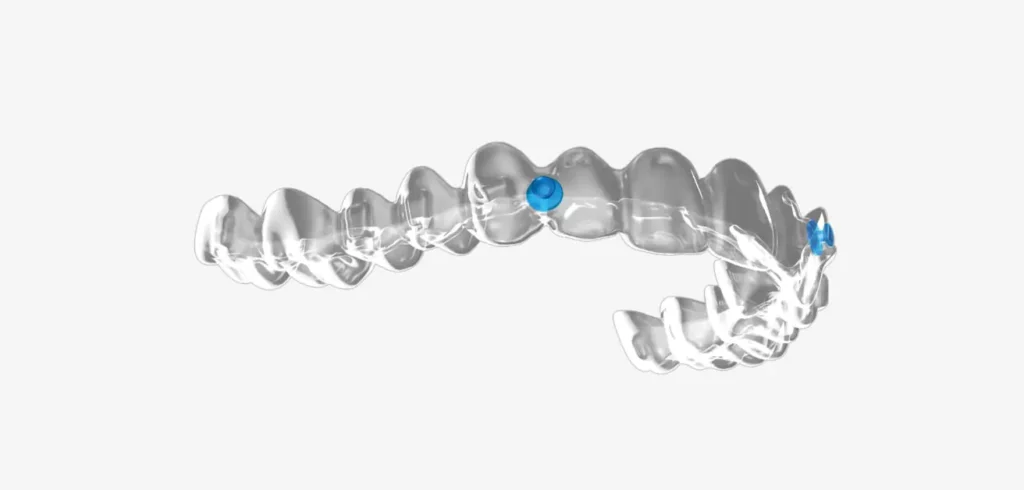 Aligners Ossa Orthodontics in Caldwell, OH